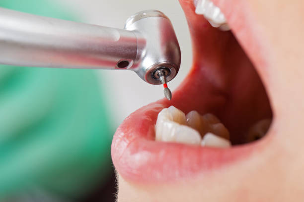Best Dentist for Tooth Abscess  in Stanley, ND